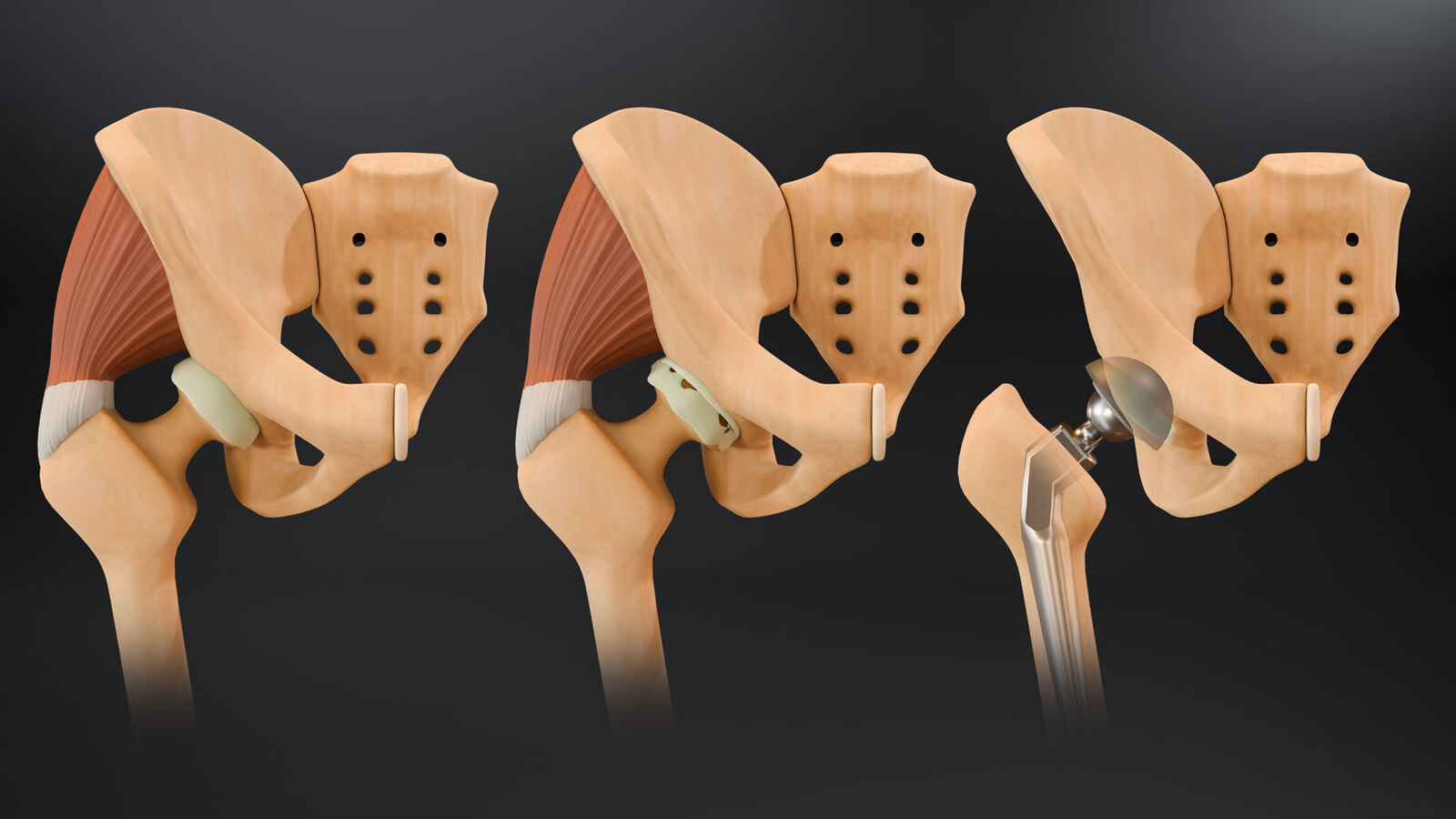 Custom 3D hip replacement illustration