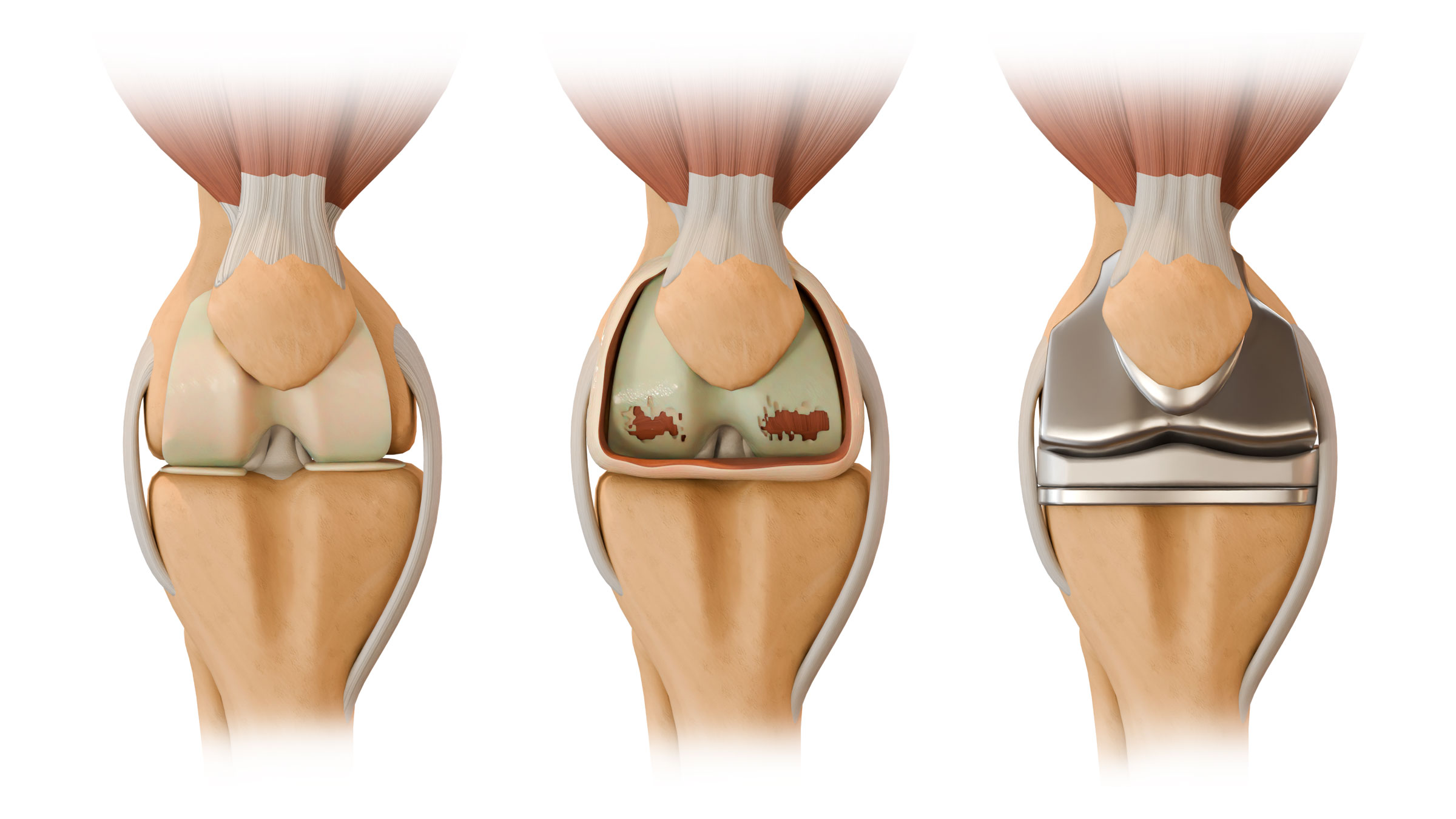 Custom 3D knee replacement illustration